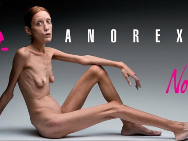 12-30-anorexia.jpg_88717827.jpg